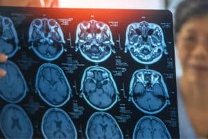 Alzheimer And Brain